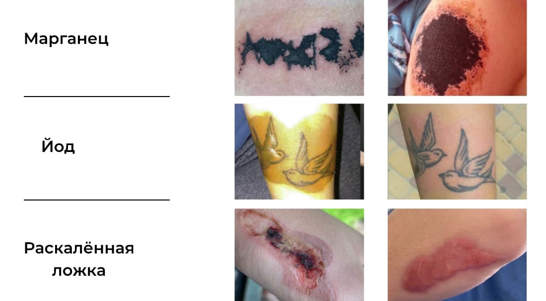Популярные способы удаления тату